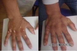 白癜风的治疗方法有哪些呢
