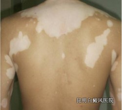 白癜风有哪些危害