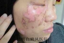 白癜风病势好转的症状是什么